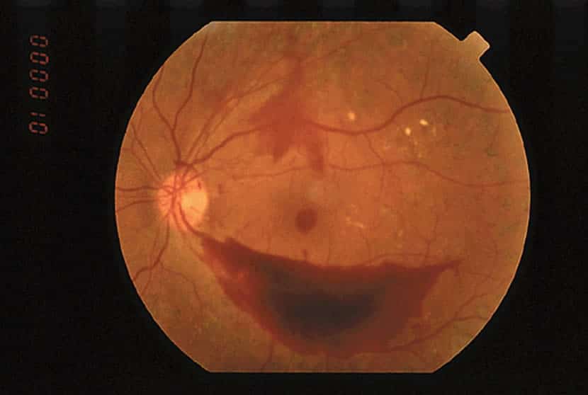 Proliferative Diabetic Retinopathy