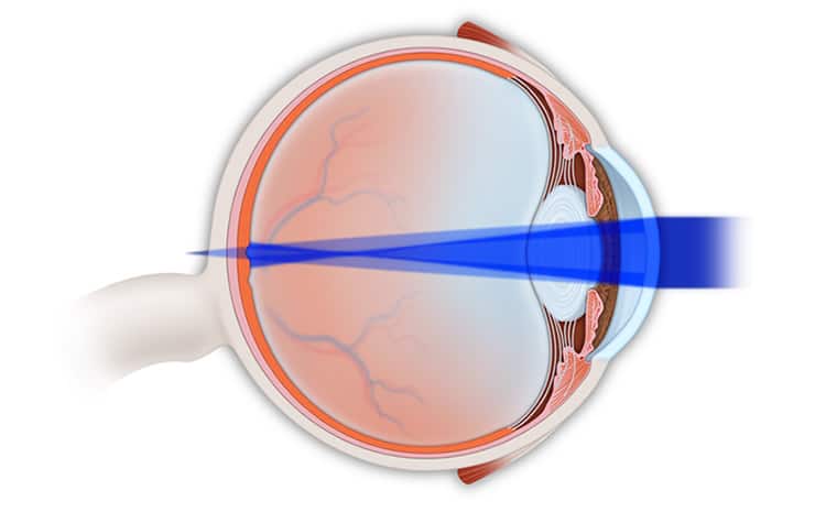 Refractive Eye Problems Treatment in NYC | Astigmatism Treatment NYC