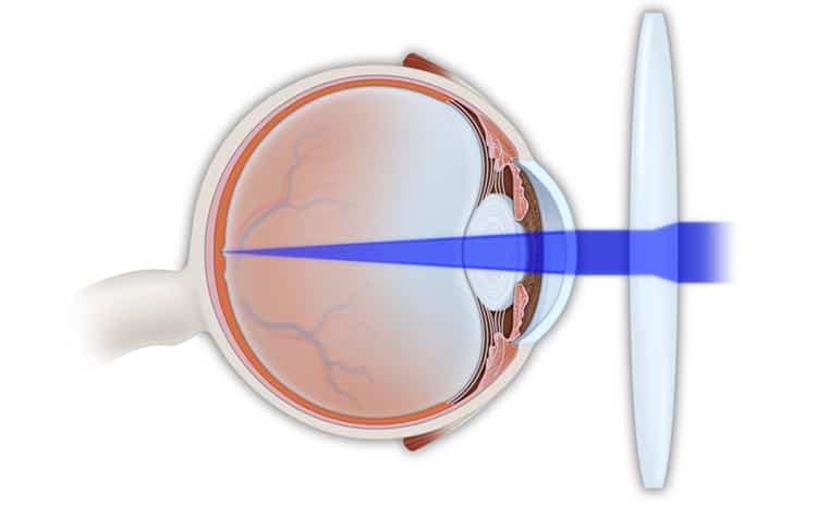 Refractive Eye Problems Treatment in NYC | Astigmatism Treatment Manhattan