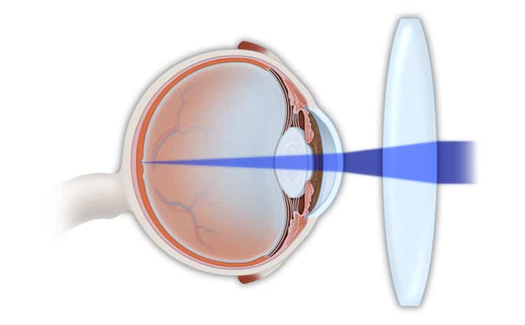 Refractive Eye Problems Treatment in NYC | Hyperopia Treatment Manhattan