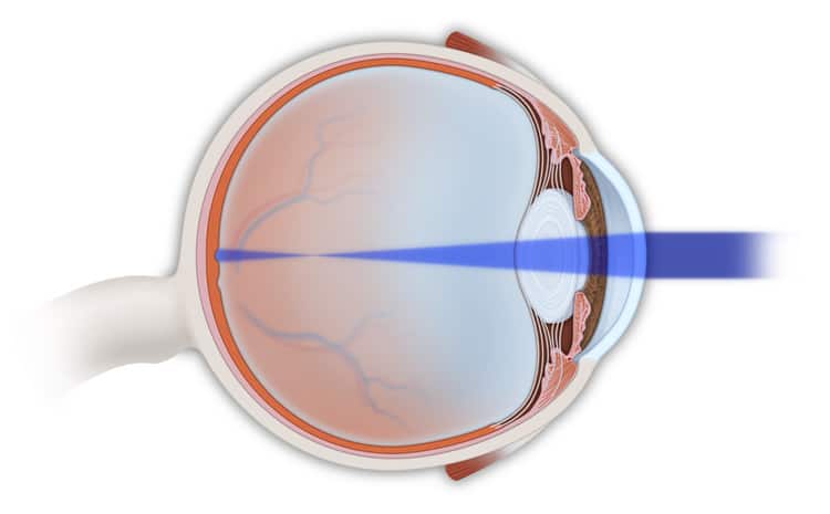Refractive Eye Problems Treatment in NYC | Myopia Treatment NYC