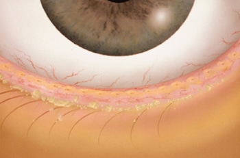 Blepharitis Treatment in NYC