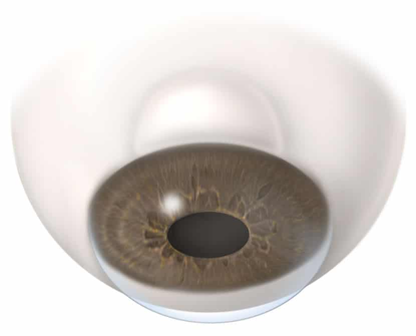 Trabeculectomy glaucoma treatment after surgery